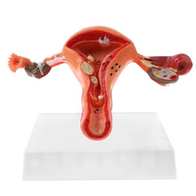 Load image into Gallery viewer, female Ovary and uterus disease Dissection model Pathology uterus model teaching human medical aids anatomy lesion uterus